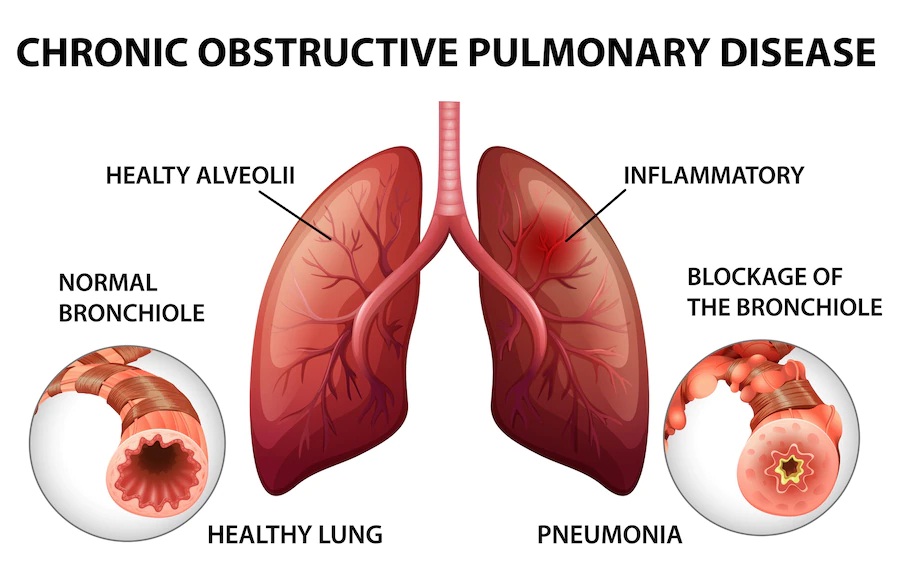 COPD: Do you have all these misconceptions about COPD?