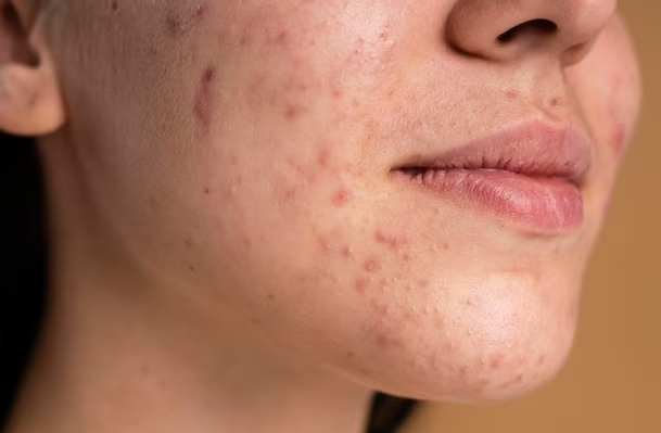 10 home remedies to treat acne