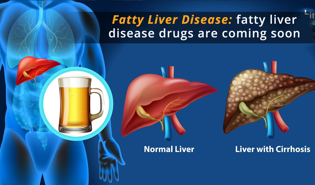 fatty liver disease drugs are coming soon